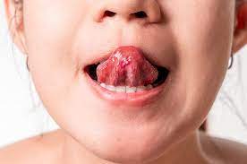 Mengenali Penyebab Dan Cara Mengatasi Mulut Kering